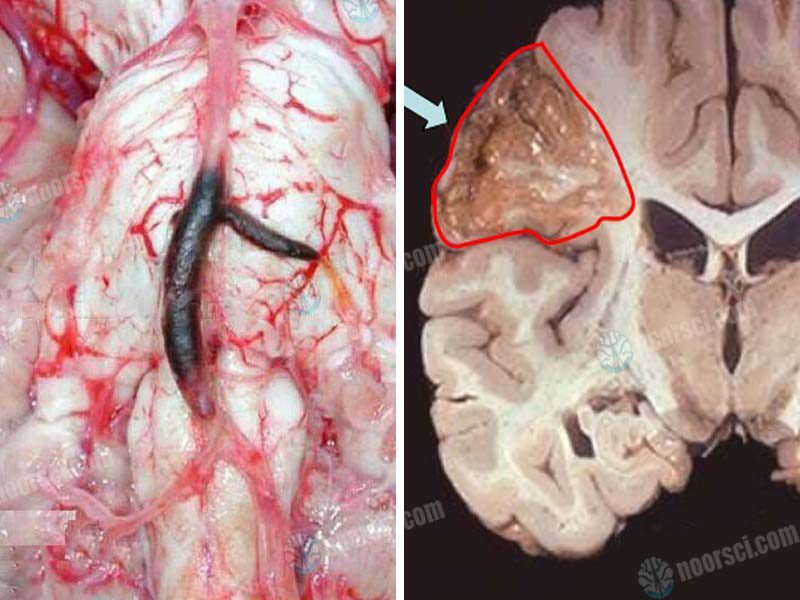 خدمات سکته مغزی