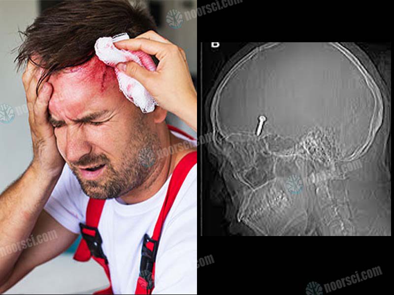 ضربه مغزی یا آسیب تروماتیک مغزی